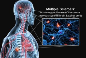 multiple-sclerosis-physiotherapist